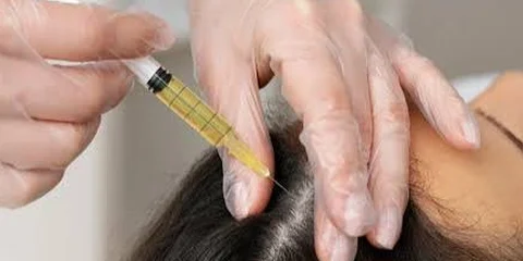 PRP injection into the scalp for hair rejuvenation